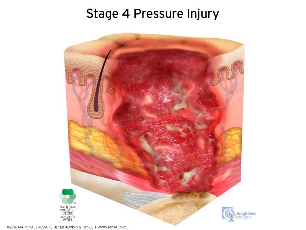 Bedsore (Pressure Ulcer) Lawyers Taking on Nursing Home Abuse
